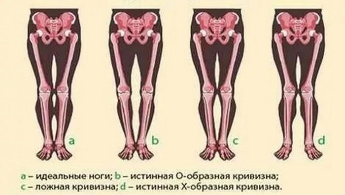 Как исправить кривые ноги: упражнения и другие методы