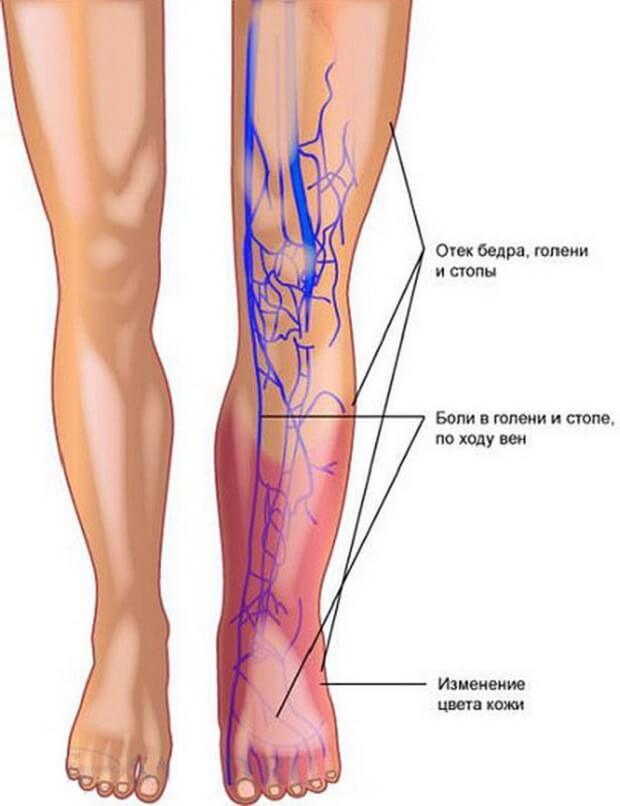 5 самых частых симптомов тромбоза вен нижних конечностей