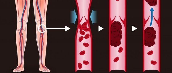 ТРОМБОЗ: Как уберечься? Факторы риска и меры профилактики