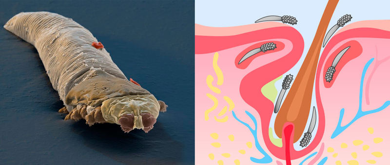 Демодекс: Подкожные клещи на лице – Что делать?