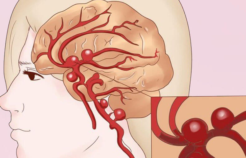 Аневризма головного мозга: 4 симптома смертельно опасного заболевания