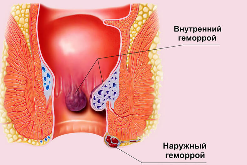 Лучшие советы для облегчения симптомов геморроя