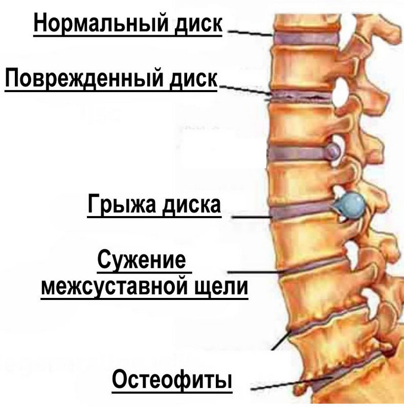 Жжение в позвоночнике: Что делать?