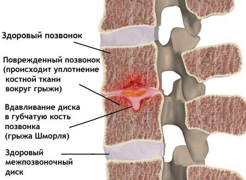 Жжение в позвоночнике: Что делать?