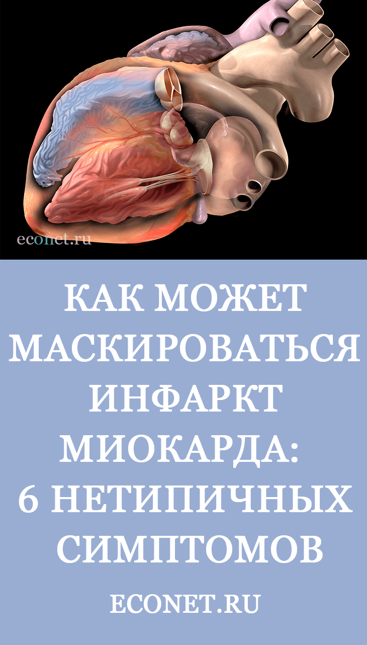 Как может маскироваться инфаркт миокарда: 6 нетипичных симптомов