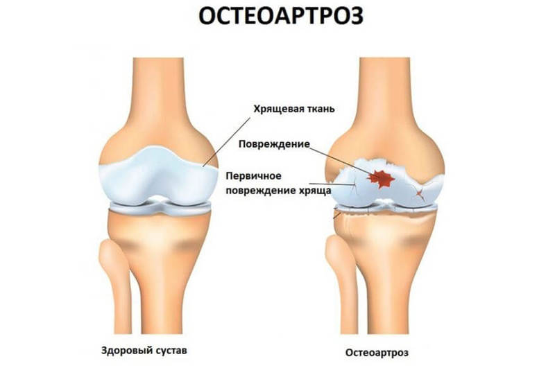 Остеоартроз: 13 доступных способов лечения 