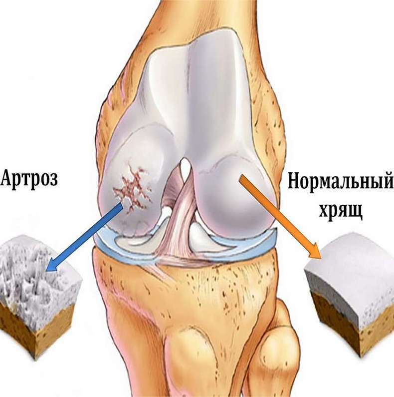 Лечебная гимнастика при артрозе суставов колена, таза, стопы и плеча  