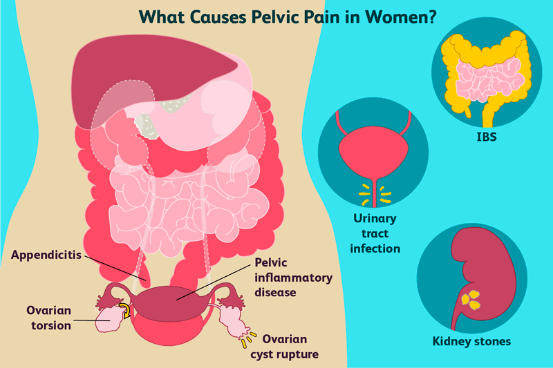 Хроническая боль в малом тазу: Виды заболеваний