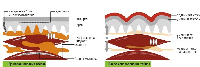 Как подтянуть кожу вокруг глаз: Тейп-лифтинг от морщин