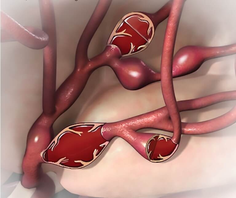 Как предотвратить разрыв аневризмы