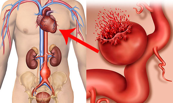 Как предотвратить разрыв аневризмы