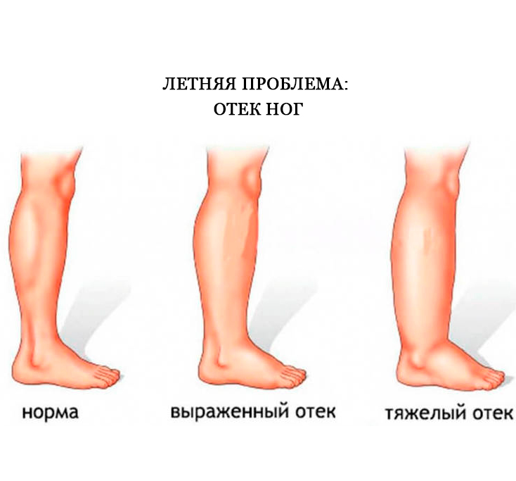 Летняя проблема: Отек ног