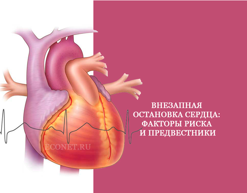 Внезапная остановка сердца: Факторы риска и предвестники