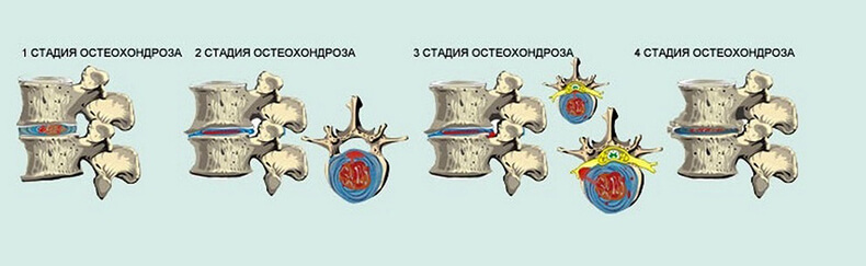 Как остановить развитие остеохондроза позвоночника