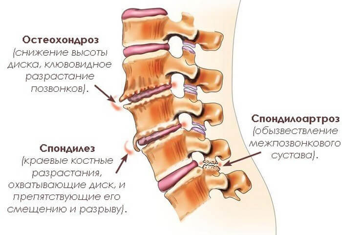 Как остановить развитие остеохондроза позвоночника