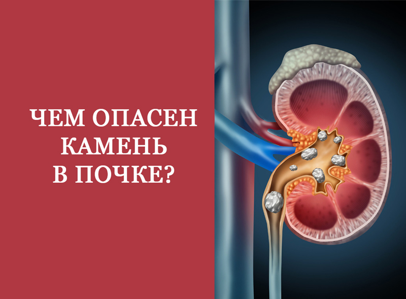 Чем опасен камень в почке? 