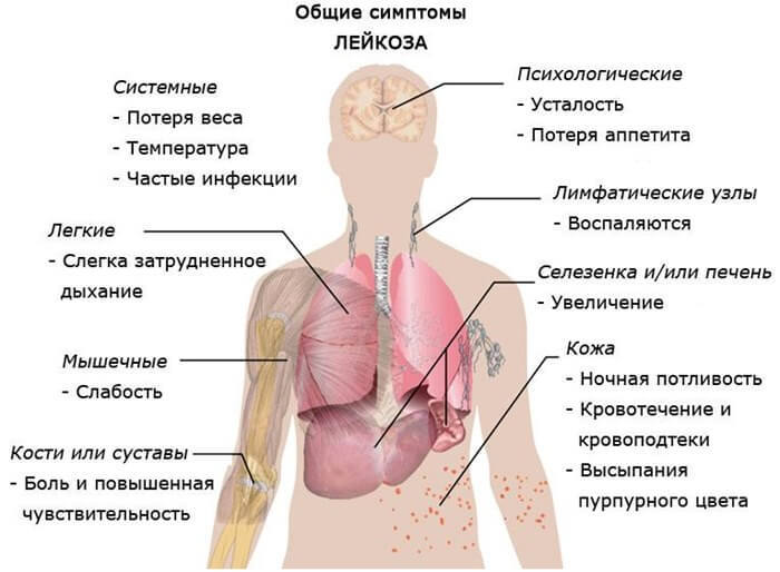 Рак крови: Основные ранние симптомы лейкоза