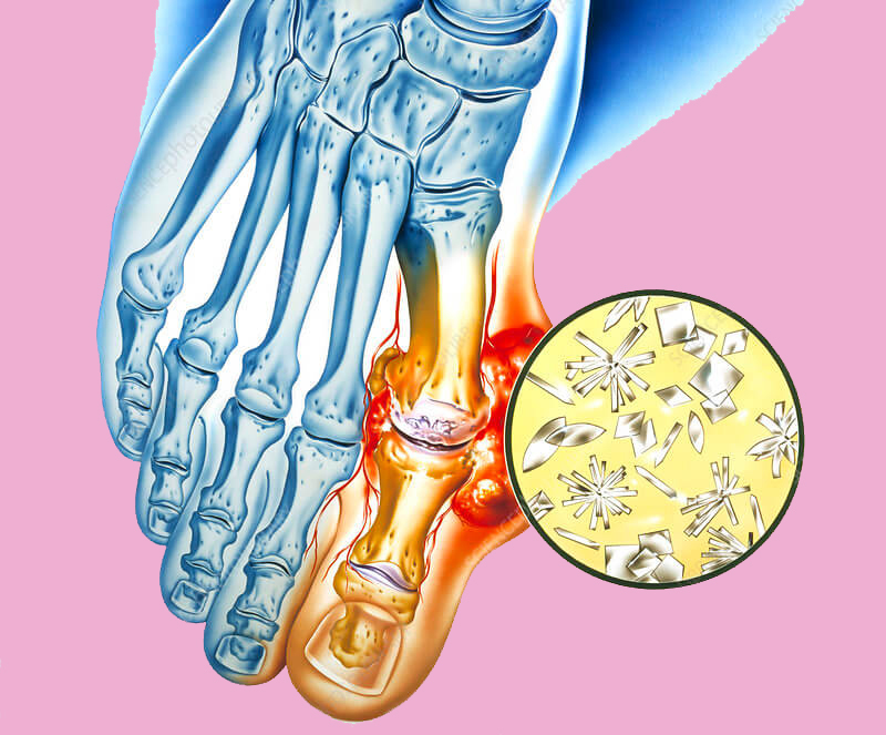 Признаки и принципы диагностики подагры