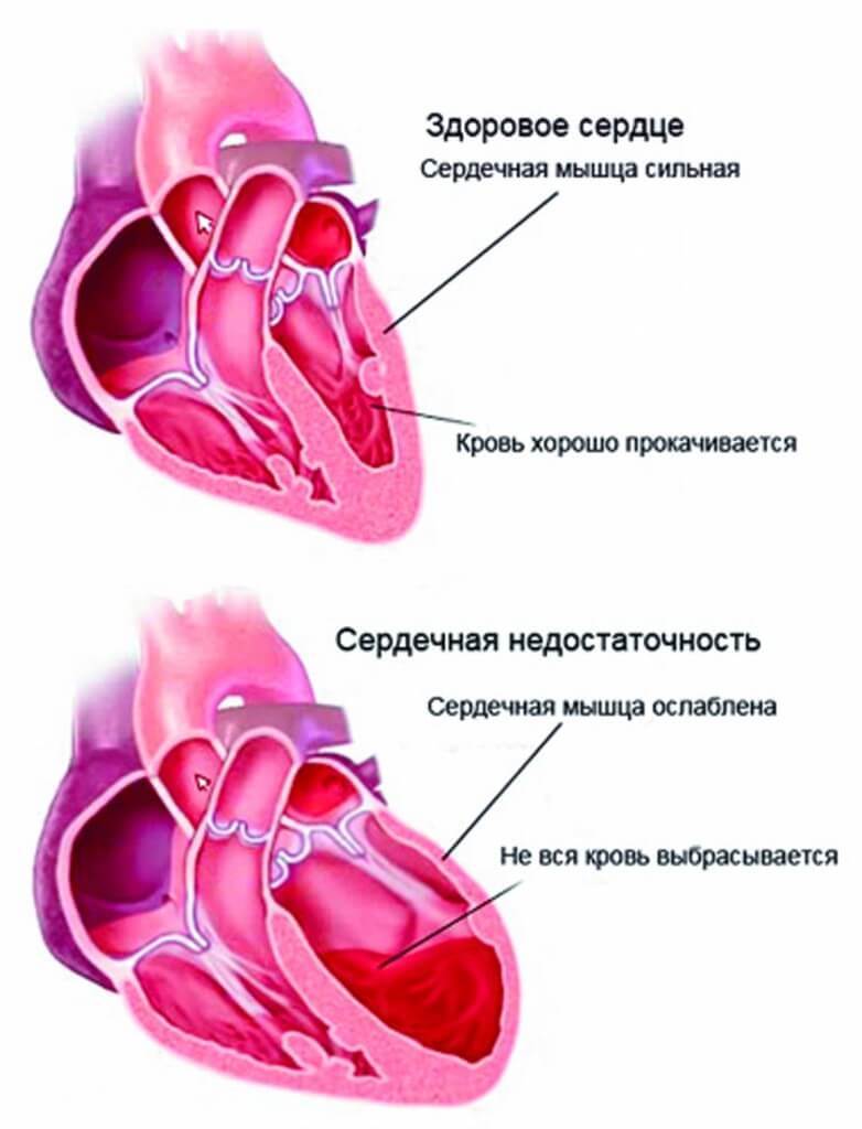 3 самых ярких симптома сердечной недостаточности