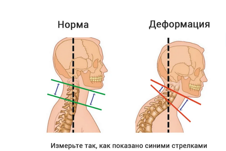 Как связана холка с поплывшим овалом лица