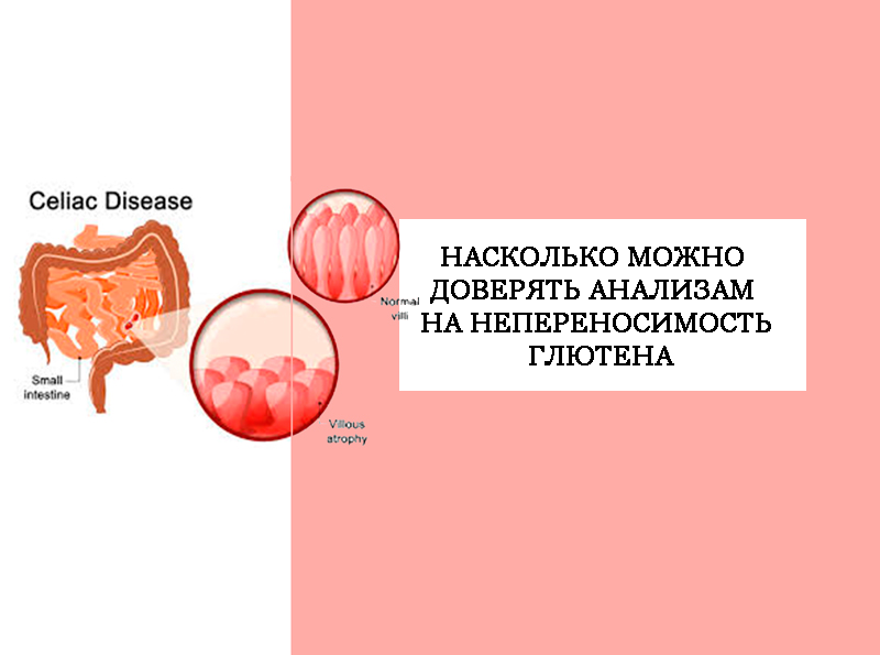 Насколько можно доверять анализам на непереносимость глютена