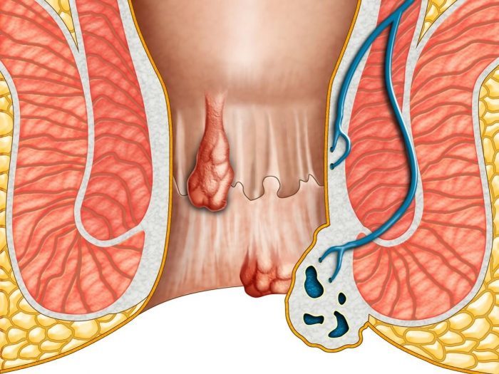 Как облегчить состояние при геморрое? Полезные советы