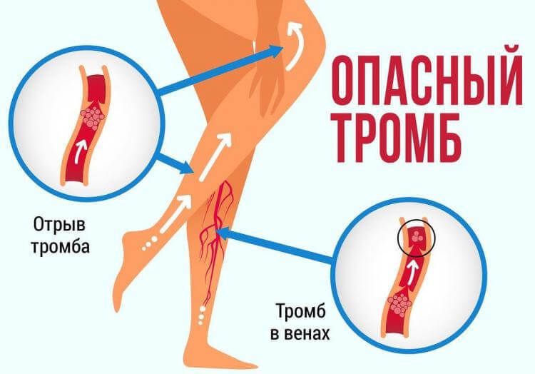 Тромб, который может вас убить мгновенно: 15 опасных признаков