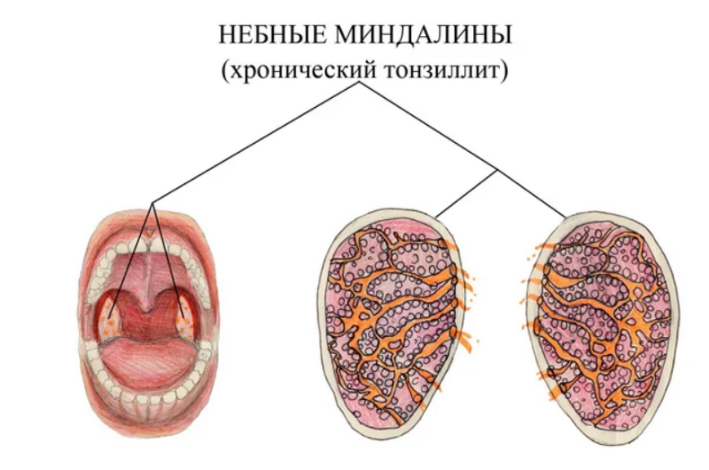 10 фактов об опасности хронического тонзиллита