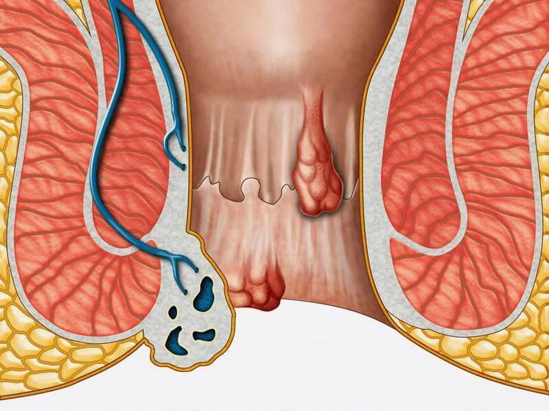 Геморрой и рак: Как отличить на ранних стадиях патологии?