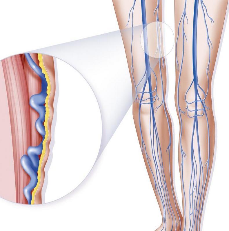 Варикозная болезнь: 7 обязательных упражнений, которые спасут ваши ноги