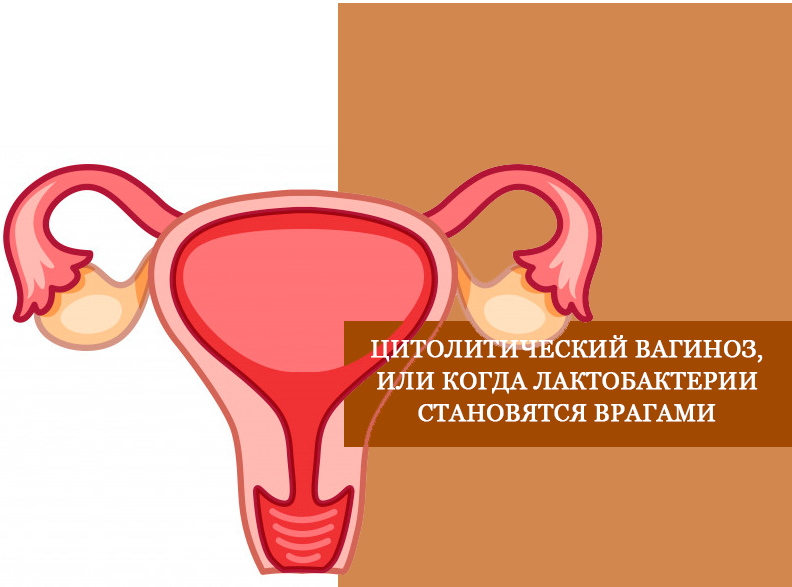 Цитолитический вагиноз, или когда лактобактерии становятся врагами