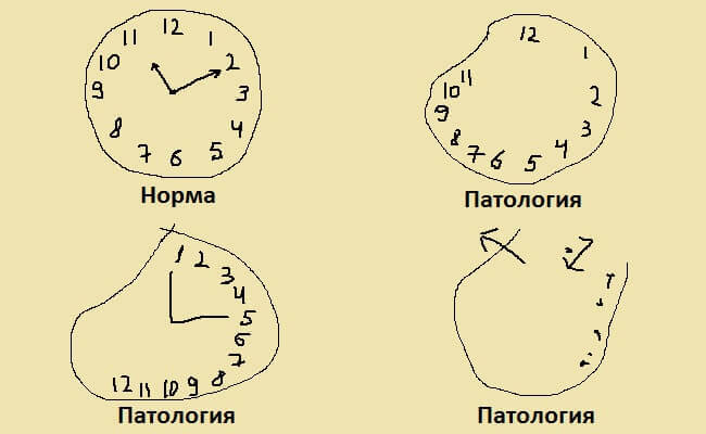 Экспресс-тесты: Проверяем себя на болезнь Альцгеймера