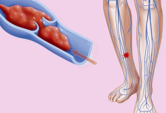 Внимание! Первые симптомы тромба в ноге