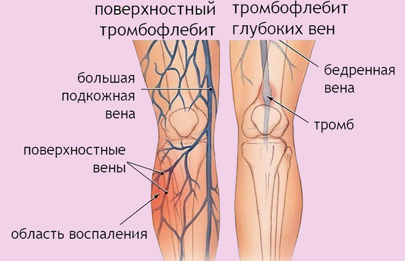 Внимание! Первые симптомы тромба в ноге