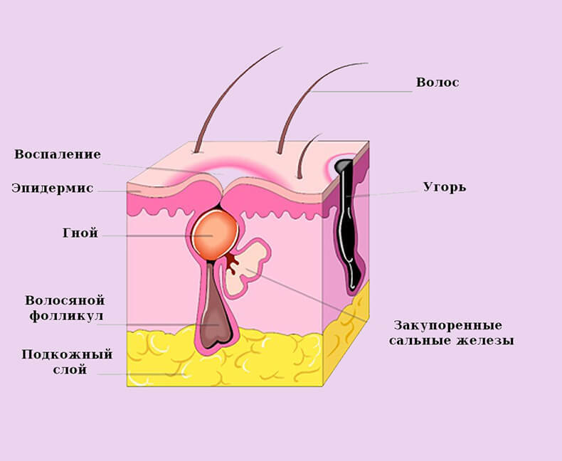 Как лечить прыщи: 6 мощных домашних средств от акне