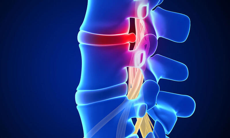 Грыжа диска. Как лечить