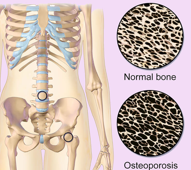Как предотвратить остеопороз