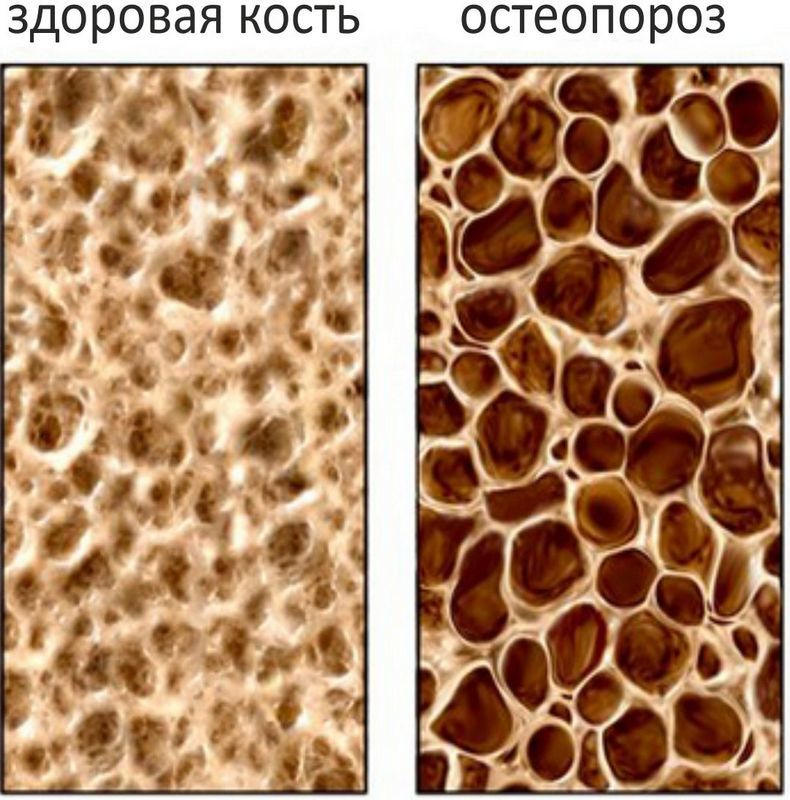Остеопороз: Как наше тело становится хрупким