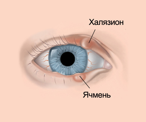 Лечение халязиона натуральными средствами