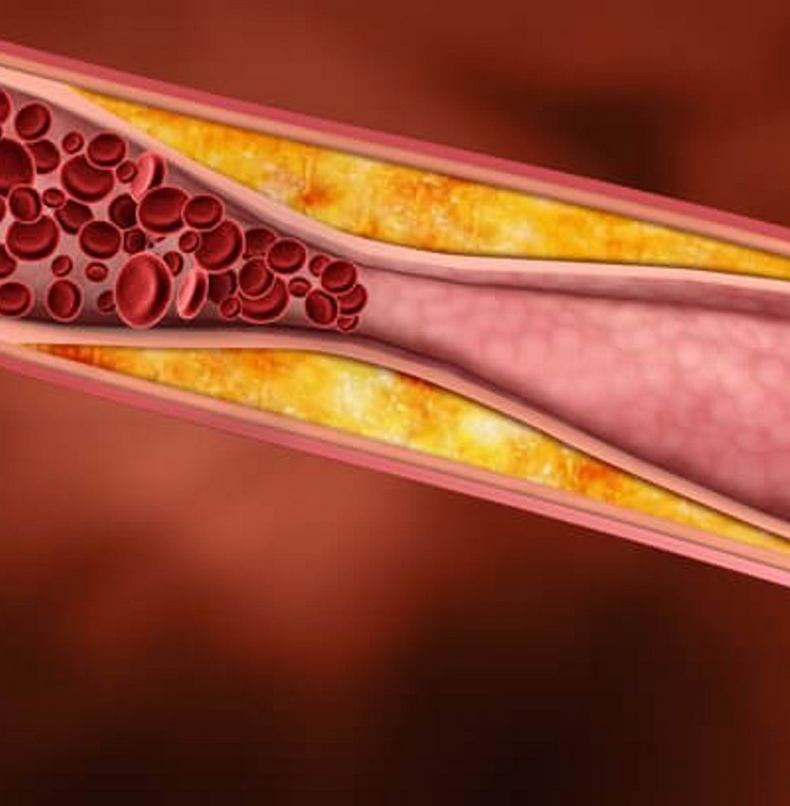 Холестериновая страшилка, в которую пора перестать верить