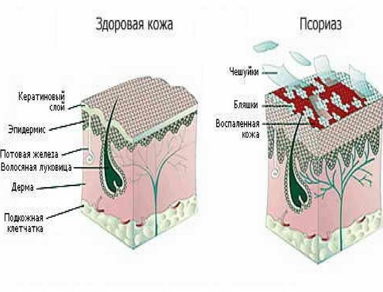 Псориаз: Как избежать обострения?