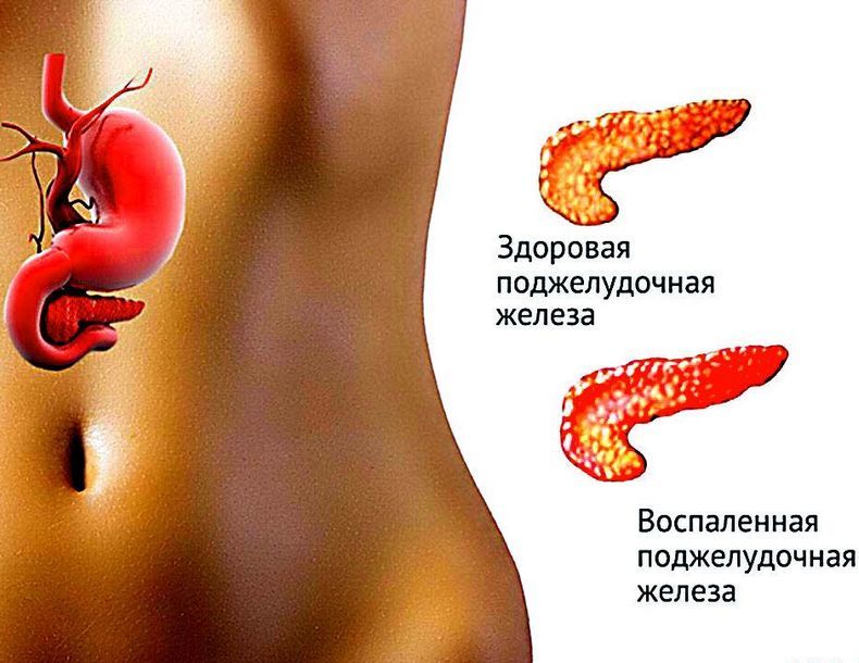 Лечение поджелудочной железы: Лучшие травы и рецепты 