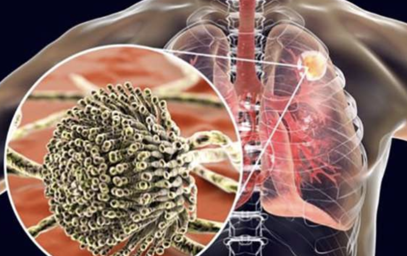 Аспергиллез: почему опасно жить рядом с плесенью