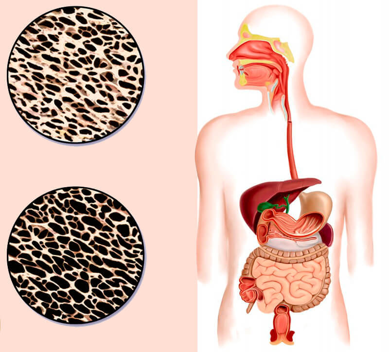 Хрупкие отношения: Как остеопороз связан с работой кишечника