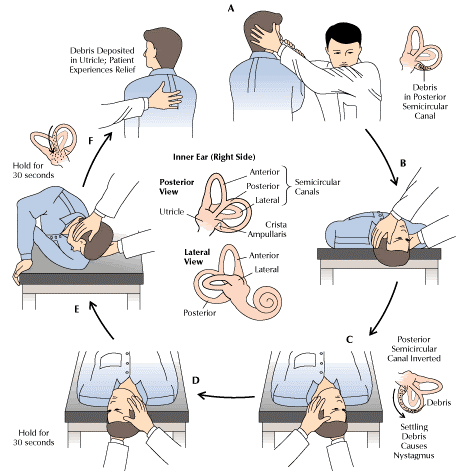 Маневр Эпли: если кружится голова, проверьте уши!