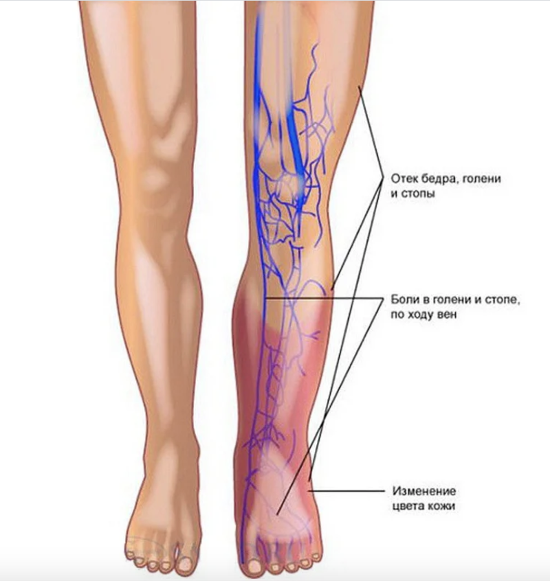 Варикоз: как распознать и остановить болезнь на ранней стадии