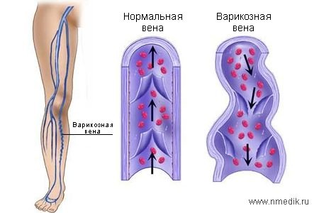 Варикоз: как распознать и остановить болезнь на ранней стадии