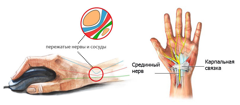 Туннельный синдром запястья – главная проблема офисных работников