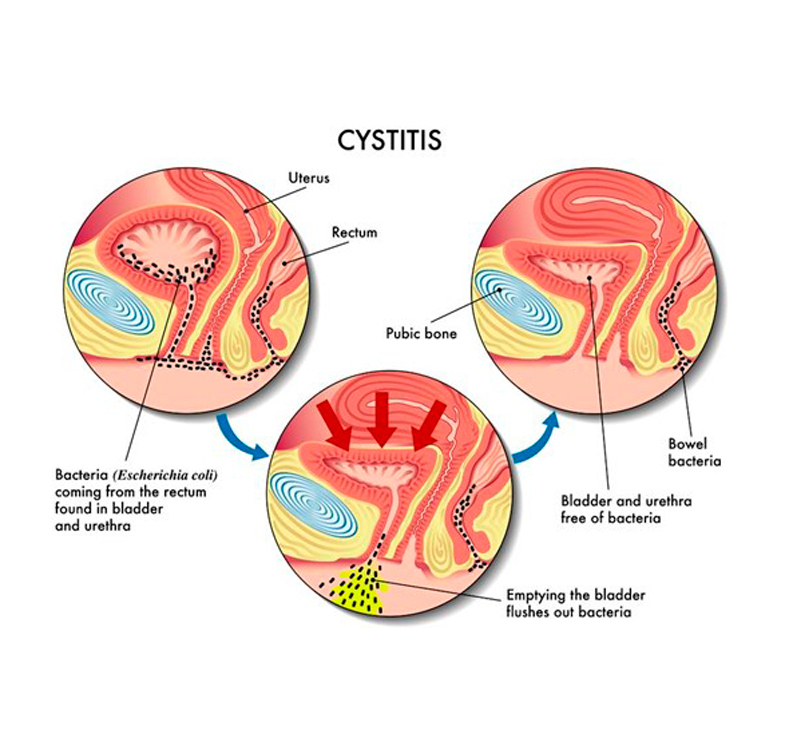 Почему появляется цистит и как вылечиться без таблеток