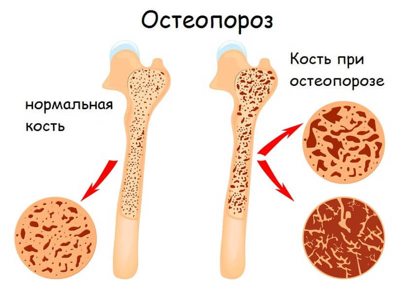 Селен поможет предотвратить остеопороз и снизить риск серьезных заболеваний